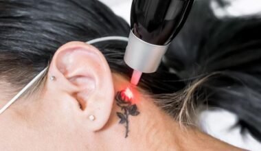 how modern lasers revolutionize tattoo removal