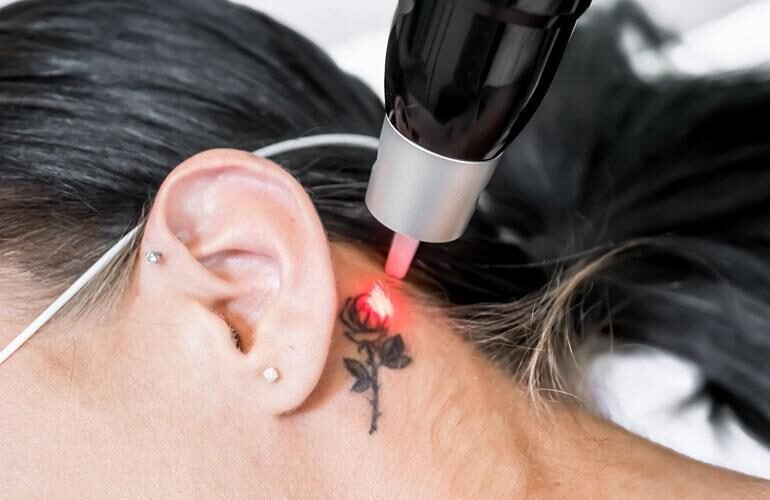 how modern lasers revolutionize tattoo removal