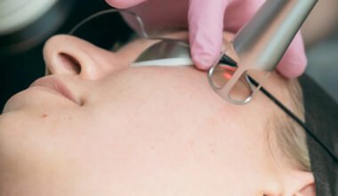 clear skin laser in wollongong