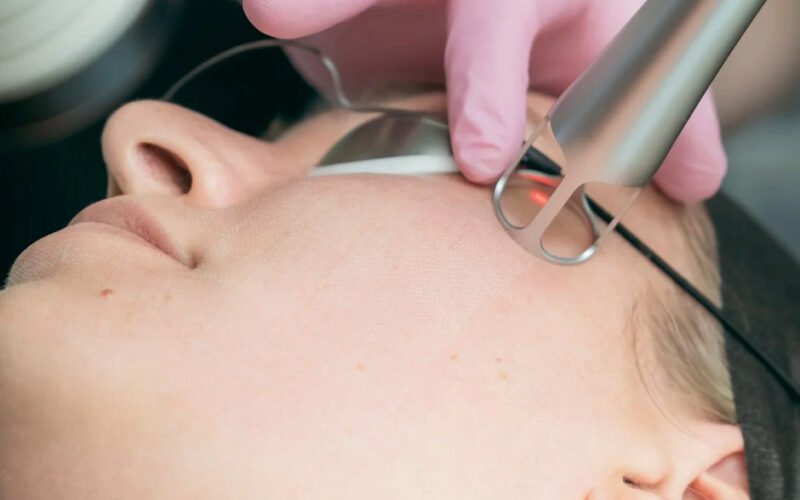 clear skin laser in wollongong