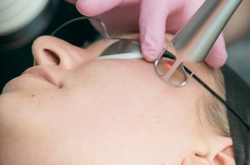 clear skin laser in wollongong