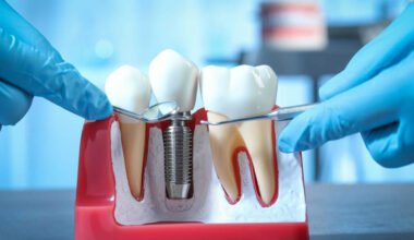 designing dental implant aesthetics