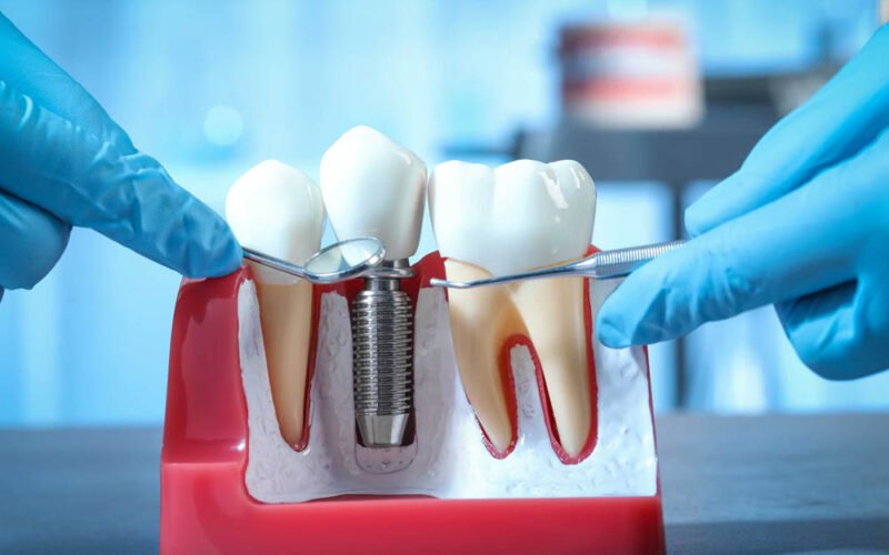 designing dental implant aesthetics