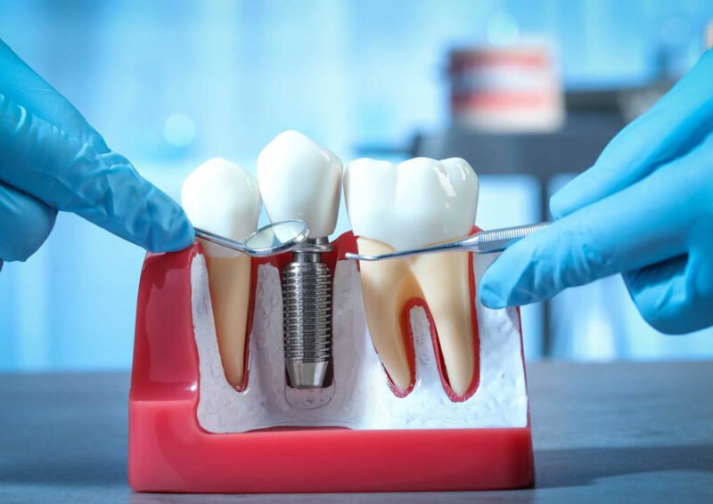 designing dental implant aesthetics