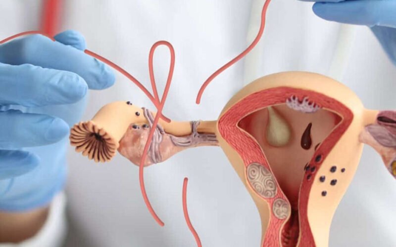 exploring safe and effective tubal reversal options