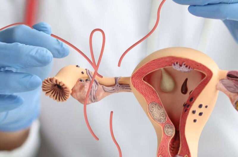 exploring safe and effective tubal reversal options