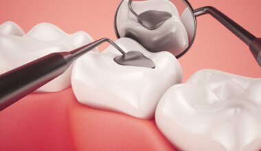 getting composite fillings