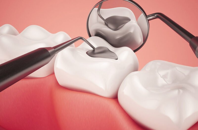 getting composite fillings