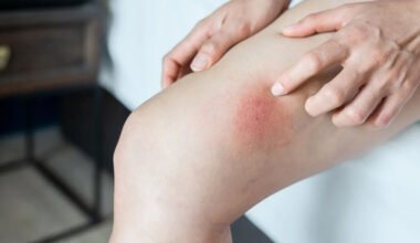 quick relief tips for healing chafed skin