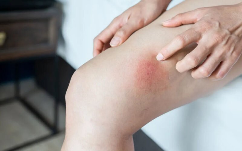 quick relief tips for healing chafed skin