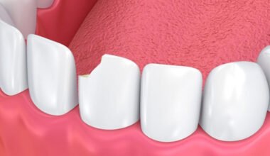 dental bonding in repairing chipped or cracked teeth