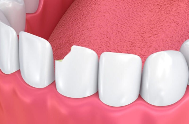 dental bonding in repairing chipped or cracked teeth