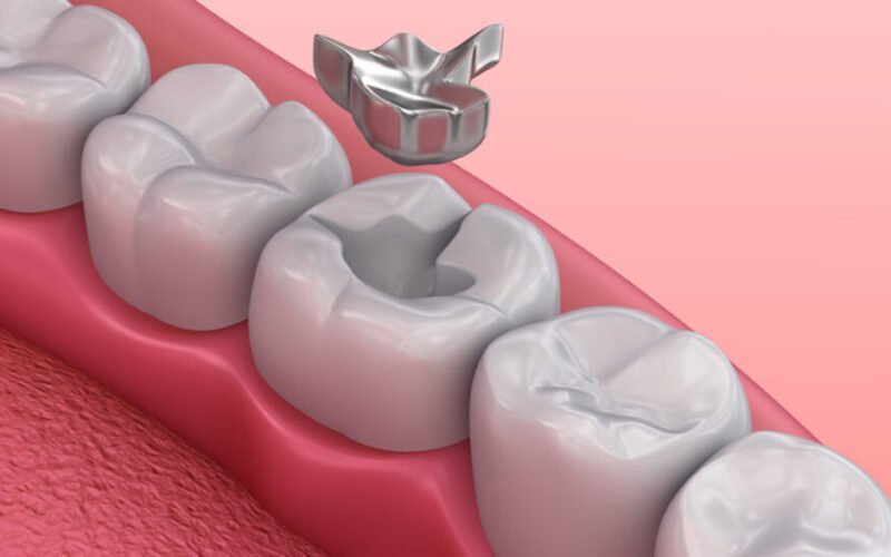 lose a dental filling or crown
