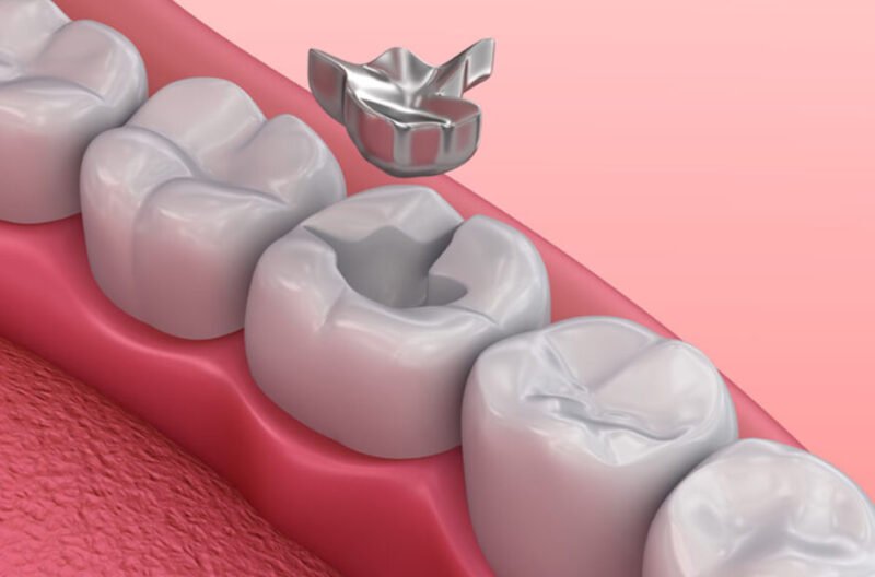 lose a dental filling or crown