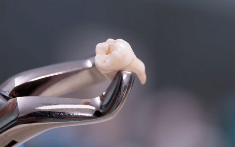 myths about teeth extraction