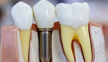 teeth replacement options