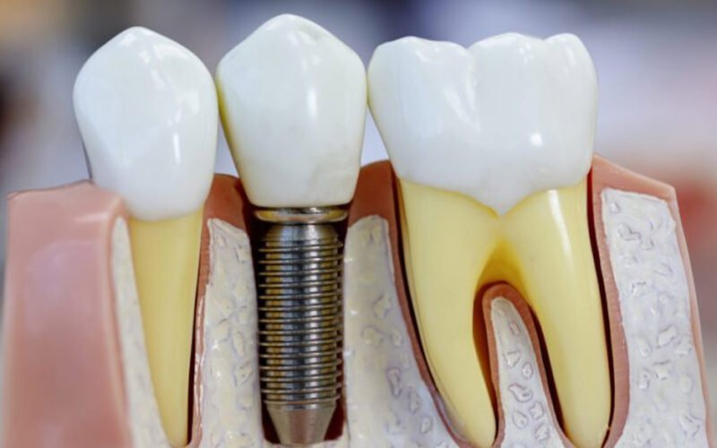 teeth replacement options