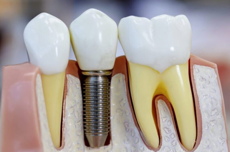 teeth replacement options