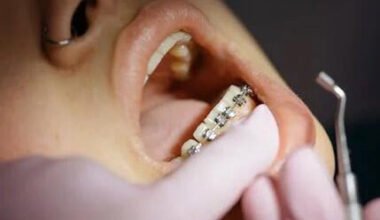 the benefits of choosing clear braces for adults and teens