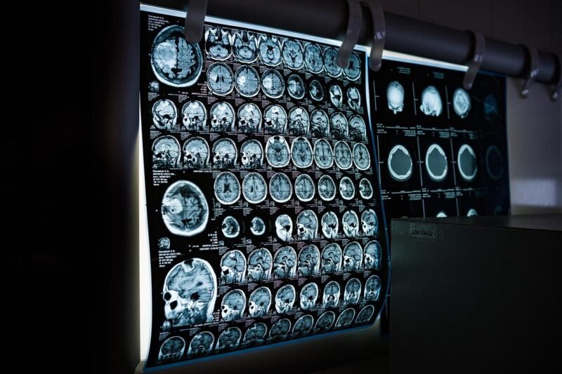 know your rights after a traumatic brain injury