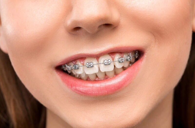 modern orthodontic solutions for straighter teeth