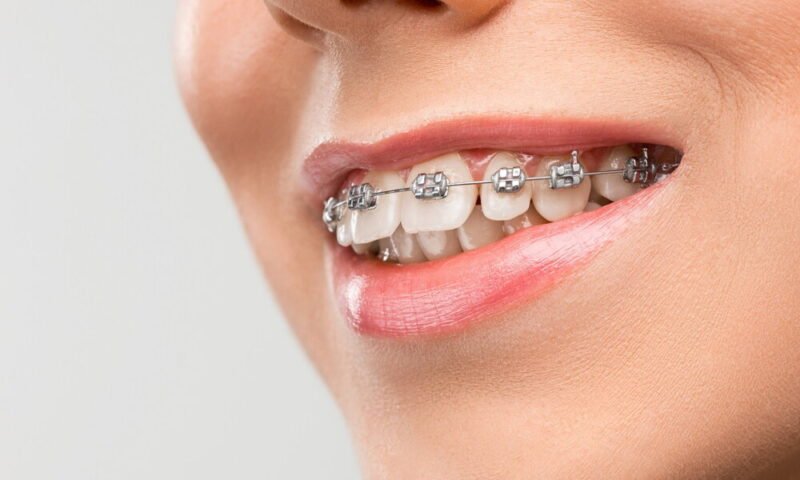 the ultimate guide to teeth aligners benefits and types