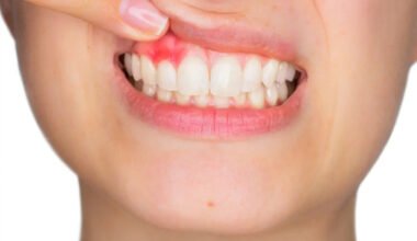 how dentists detect early signs of gum disease