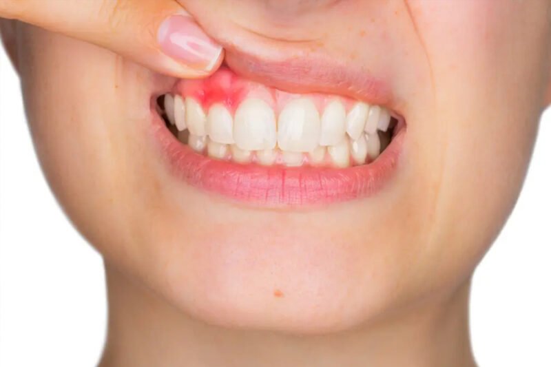 how dentists detect early signs of gum disease