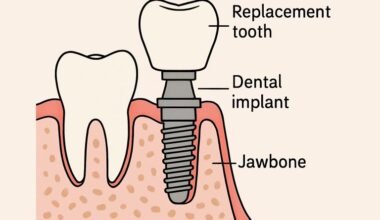 smile renewal with dental implants
