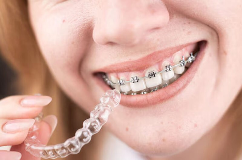 the hidden benefits of clear aligners for adults