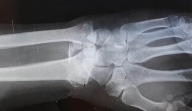 5 signs you may have a fracture