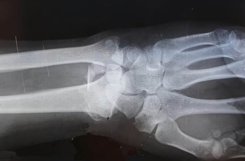 5 signs you may have a fracture