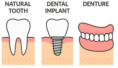 dental implants