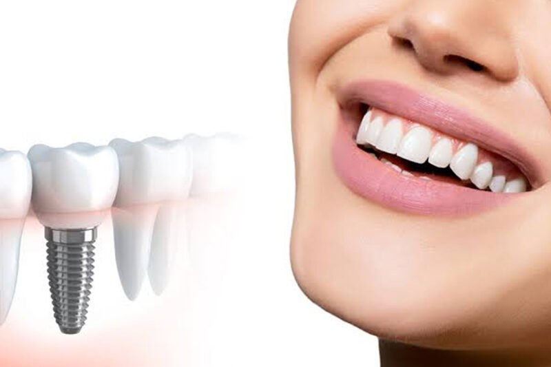 what to know before getting dental implants a patient checklist