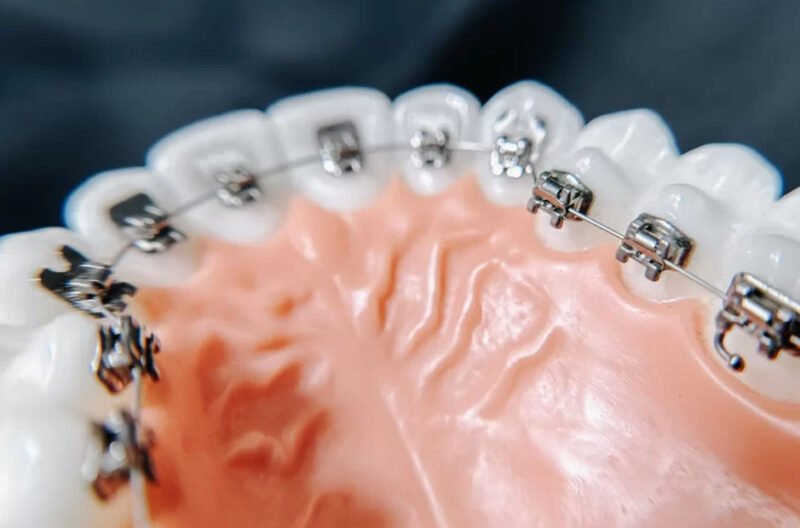 common orthodontic myths parents still believe and what science actually says