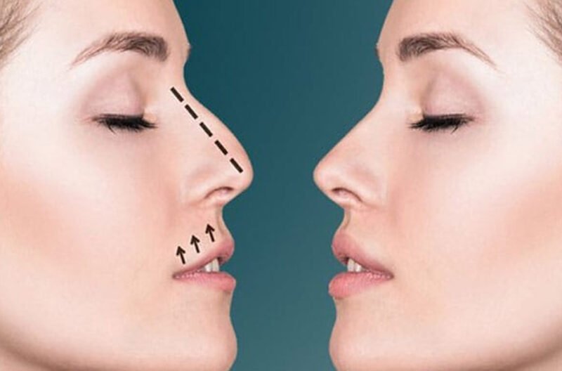 rhinoplasty