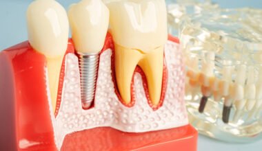 long lasting tooth replacement for confident smiles