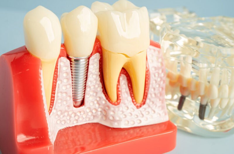 long lasting tooth replacement for confident smiles