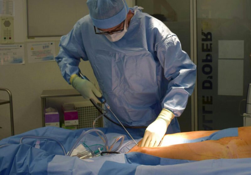 key questions to ask your surgeon before undergoing liposuction