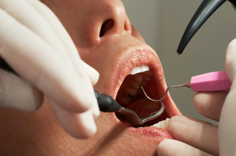debunking common dental myths