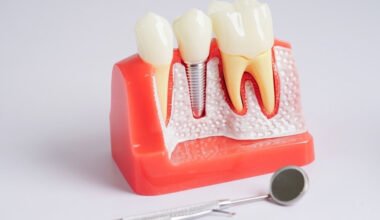 the complete guide to dental implants