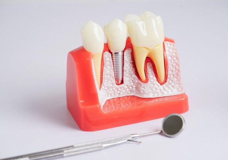 the complete guide to dental implants